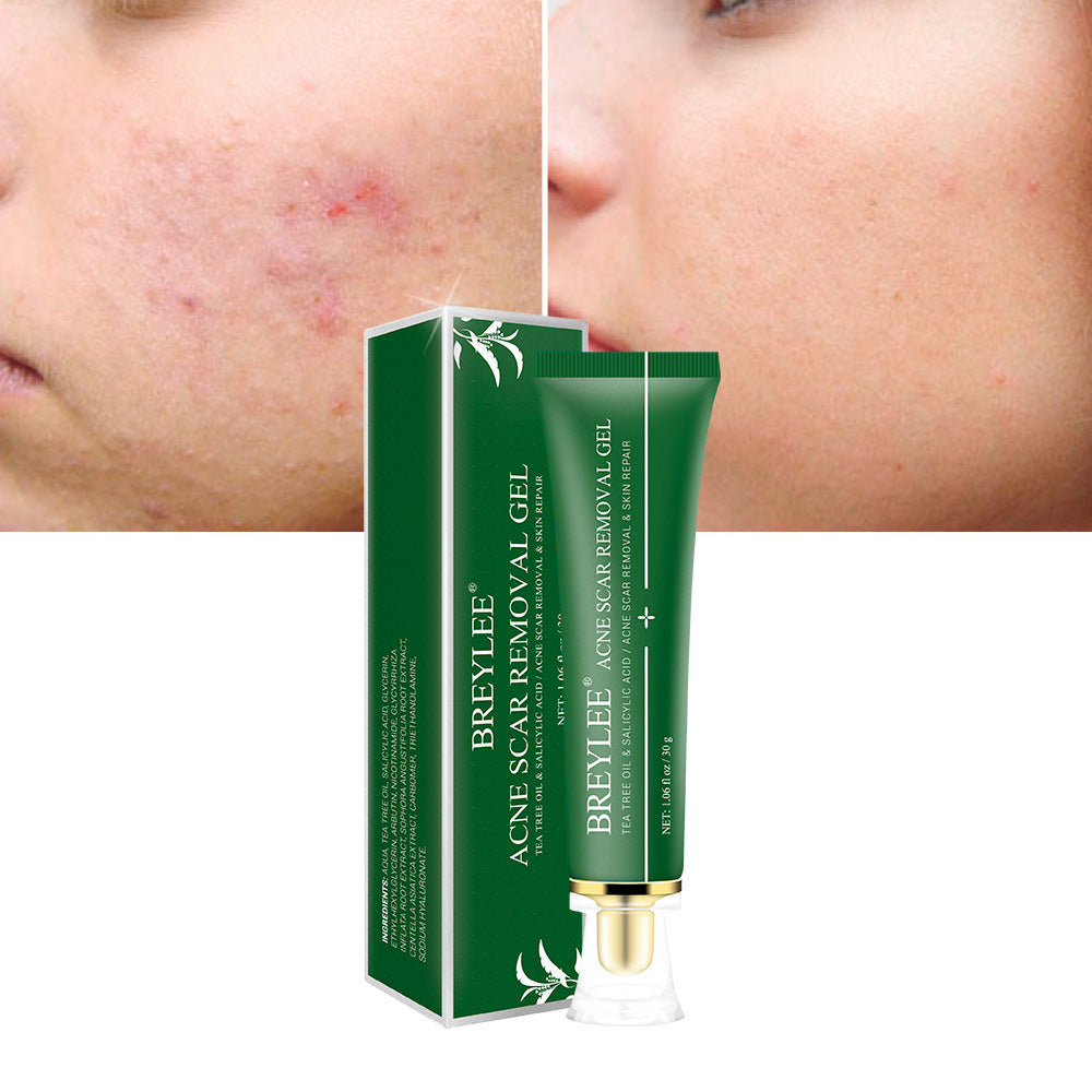 Natural Acne Scar Fading Gel with Tea Tree – Gentle & Effective
