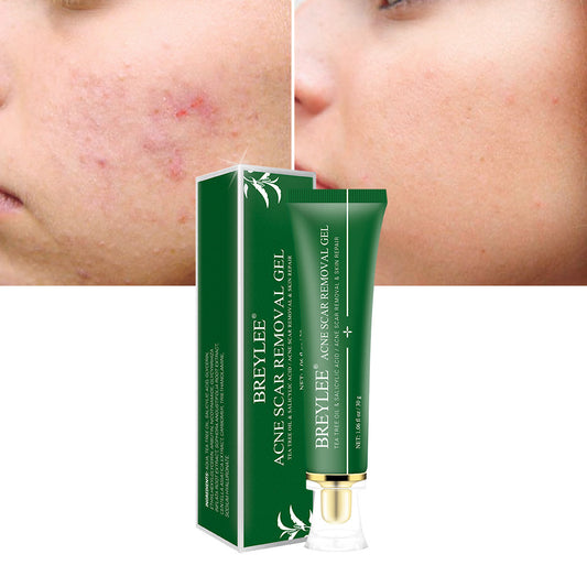 Natural Acne Scar Fading Gel with Tea Tree – Gentle & Effective