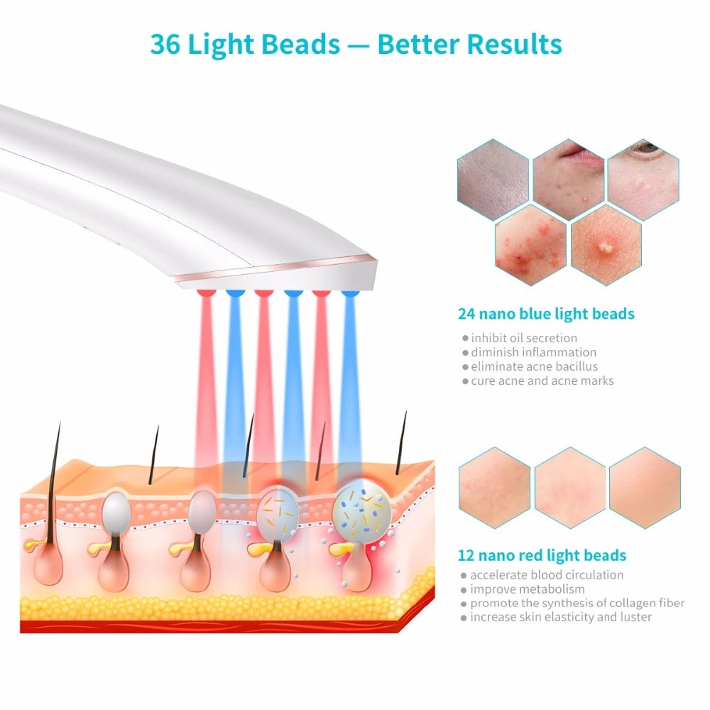 Clear Skin Anywhere – Xpreen Wireless Light Therapy Acne Eraser