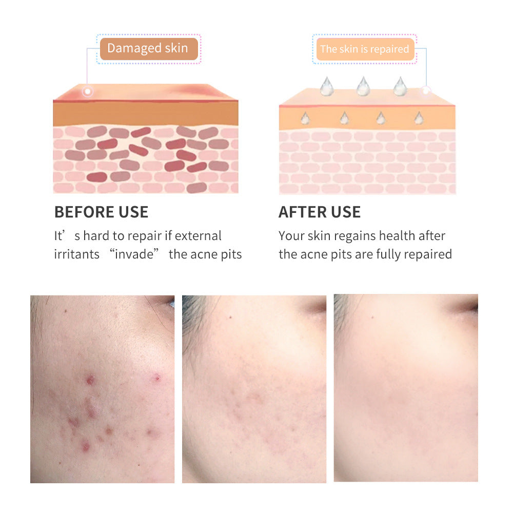 Natural Acne Scar Fading Gel with Tea Tree – Gentle & Effective