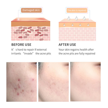 Natural Acne Scar Fading Gel with Tea Tree – Gentle & Effective